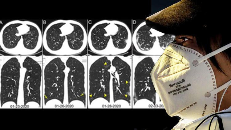 Koronavirüsten ölen Çinli adamın röntgen fotoğrafları ortaya çıktı! Virüs akciğerlere bunu yapıyor - Sayfa 1