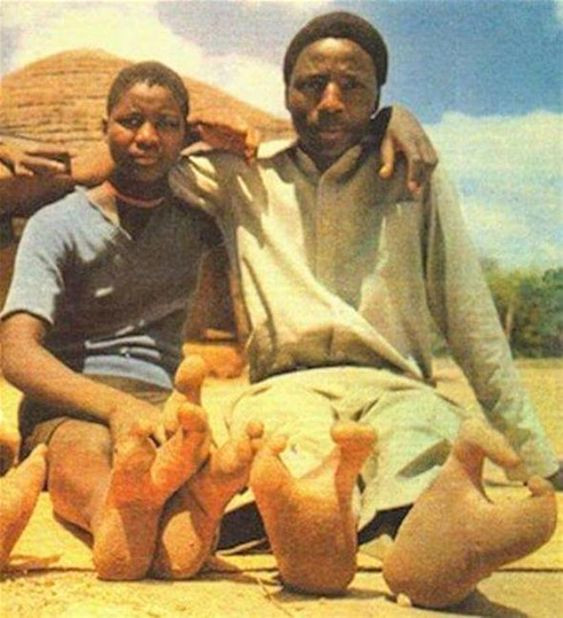 Zimbabwe'de yaşayan bu kabilenin sadece 2 ayak parmağı var ! - Sayfa 2