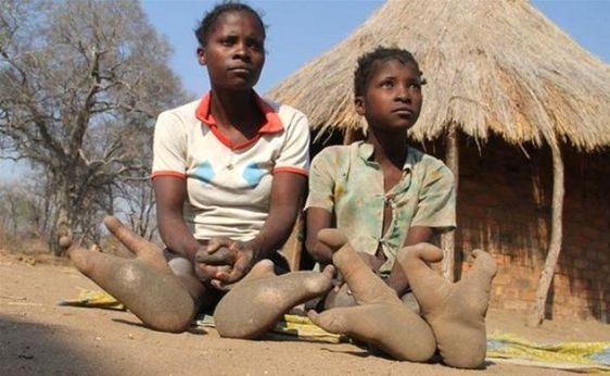Zimbabwe'de yaşayan bu kabilenin sadece 2 ayak parmağı var ! - Sayfa 4