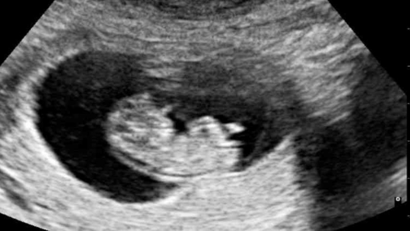 Ultrasonda bebeğin kalbindeki parlaklık ne anlama gelir?