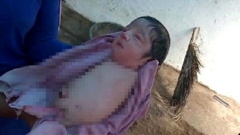 Hindistanda kolsuz ve bacaksız bebek dünyaya geldi