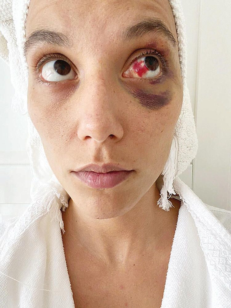 İşte kadına şiddetin fotoğrafları! Ozan güven beni böyle dövdü - Sayfa 2