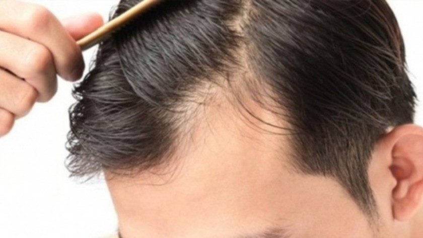 Saç dökülmesi yaşayan erkekler için 9 mucizevi yağ !