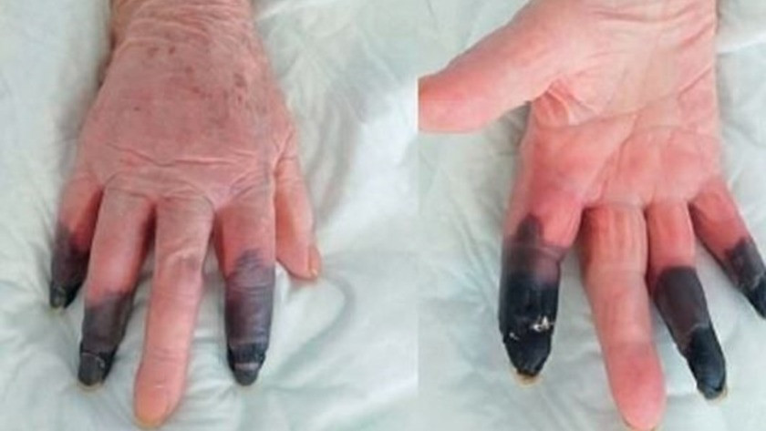 Koronavirüs hastası kadın kangren oldu, 3 parmağı kesildi