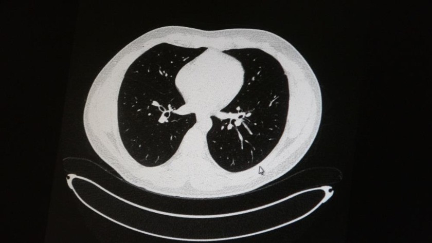 Aşılı ve aşısız olarak koronaya yakalanan 2 gencin akciğer tomografisi