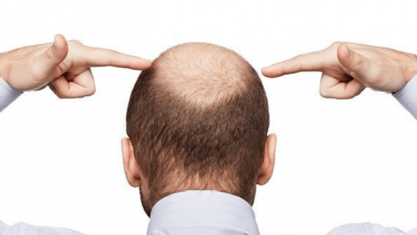 Saç ektirmek ve peruk kullanmak caiz midir? İşte Diyanet'in yanıtı