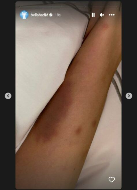 Ünlü model Bella Hadid sevenlerini korkuttu! Hasta yatağından o görüntüleri paylaştı - Sayfa 4