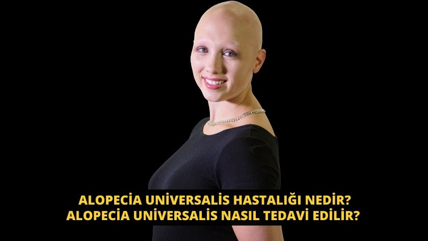 Alopecia Universalis hastalığı nedir? Alopecia Universalis nasıl tedavi edilir?