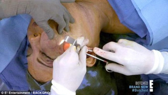 Sahte doktor yüzüne çimento enjekte etti!