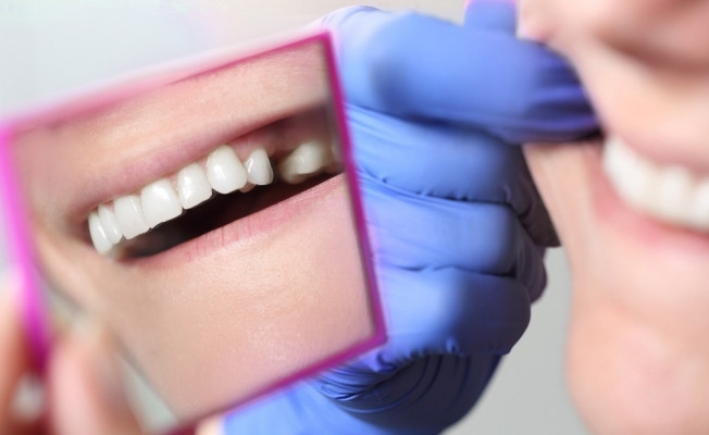 Diş çekmek yerine kanal tedavisi