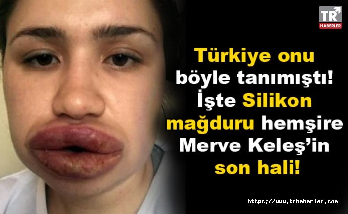 Türkiye onu böyle tanımıştı! İşte Silikon mağduru hemşire Merve Keleş’in son hali!
