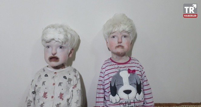 Albino kardeşler yardım bekliyor | Albino hastalığı nedir?