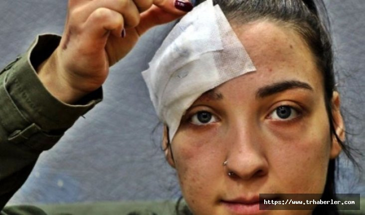 Trafik kazasında yaralanan genç kızın kafasından bakın ne çıktı!