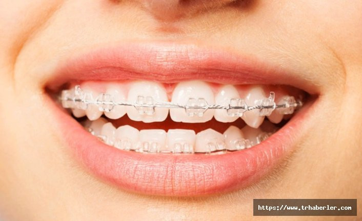 Diş teli neden takılır ne kadar süreyle dişte kalır?