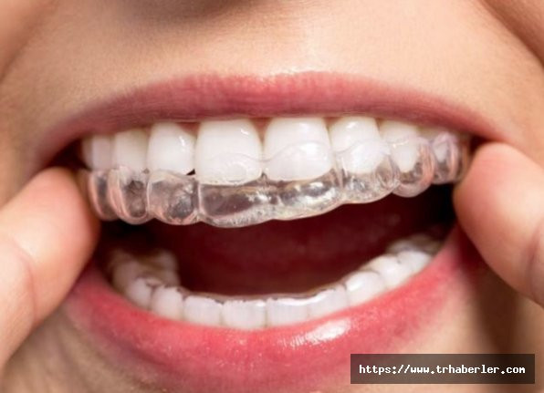 Diş teli taktırmak istemeyenleri sevindirecek haber: Bu iki yöntemi deneyin!