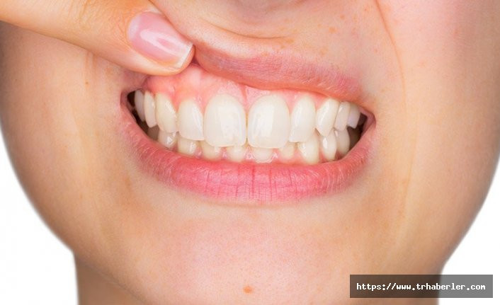 Sağlıklı diş eti rengi nasıl olur?