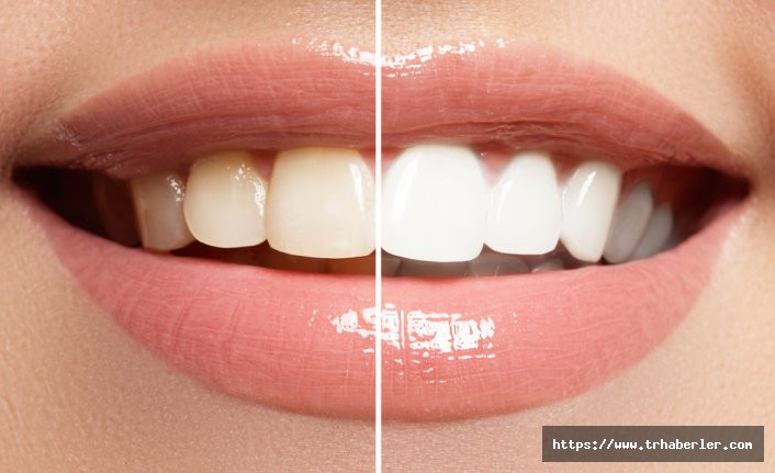 Dişlerinizi nasıl beyazlatırsınız? İşte uzmanından önemli tavsiyeler